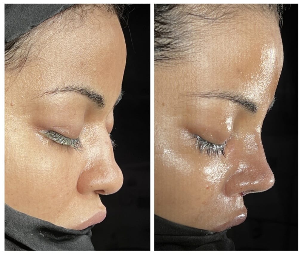 Dorsal Augmentation Rhinoplasty